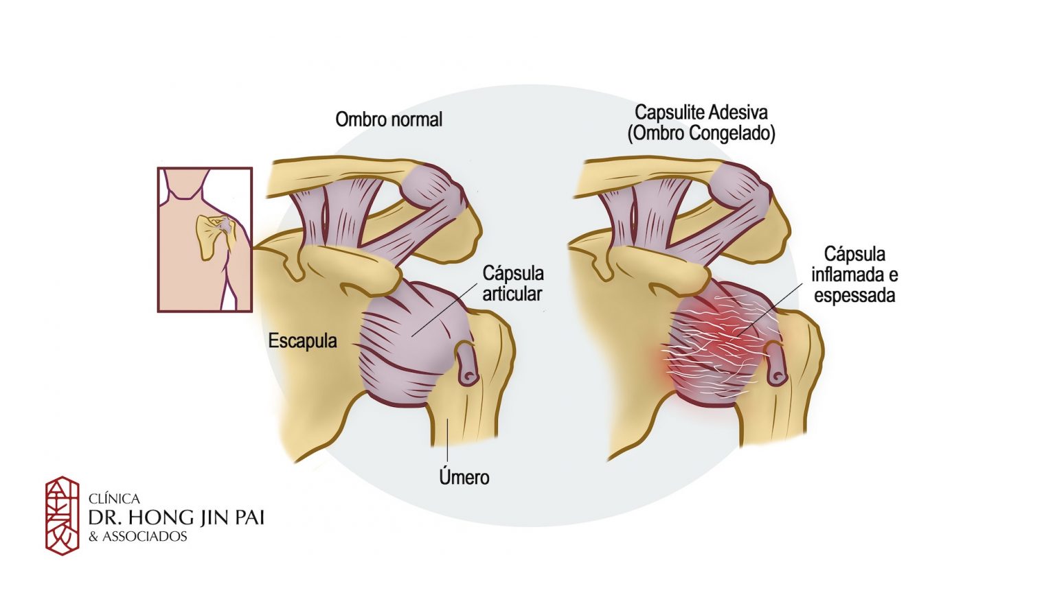 Capsulite Adesiva Ombro Congelado Cl Nica Dr Hong Jin Pai Dor