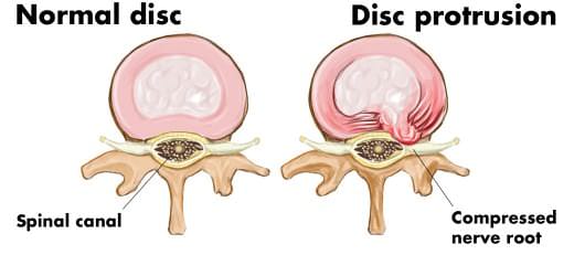 Protrusão discal sintomas e tratamento Clínica Dr Hong Jin Pai