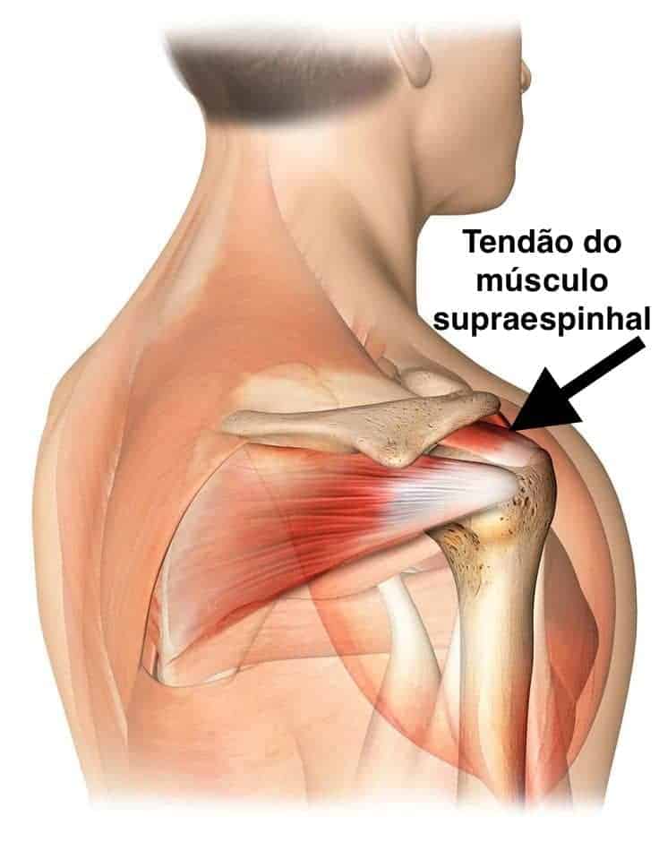 Tendinopatia do Supraespinhal O que é causas sintomas e tratamentos Clínica Dr Hong Jin