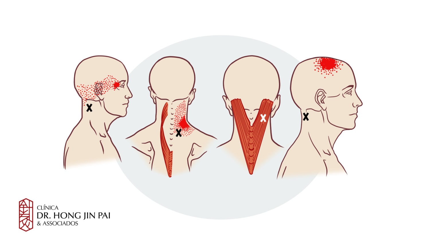 Pontos-Gatilho - Pontos De Tensão Muscular - Clínica Dr. Hong Jin Pai ...