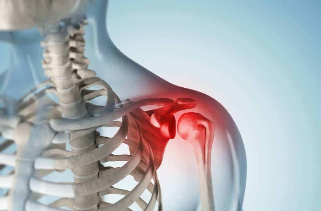 Síndrome do impacto no ombro: conceito, causas, sintomas e tratamento