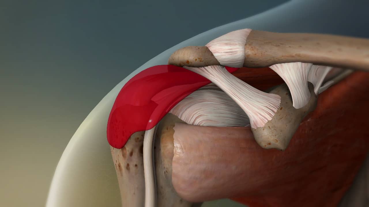 Bursite No Ombro Subacromial Bursitis Shoulder Impingement Bursitis The Best Porn Website