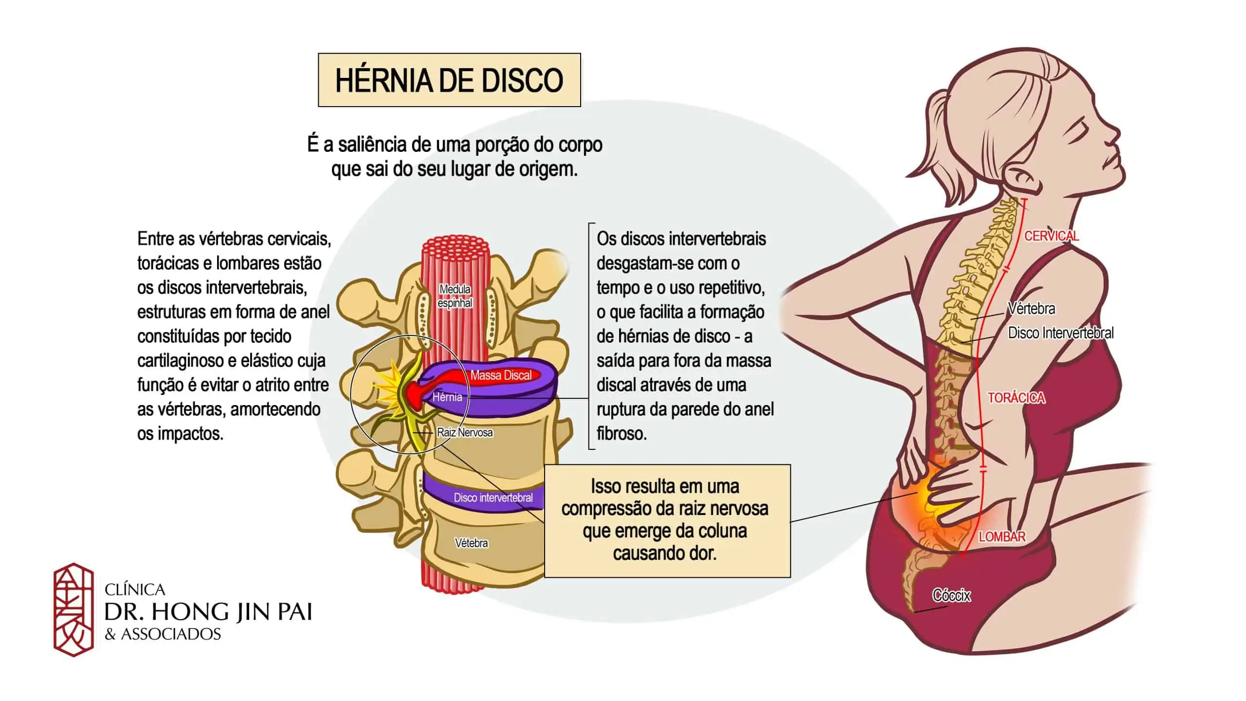 Hérnia de Disco: O que é, Causas, Sintomas e Tratamentos